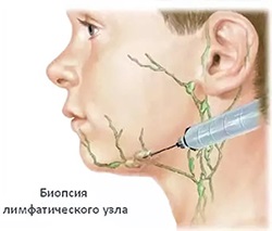 Nyaki nyirokcsomó biopszia (nyirokcsomó)