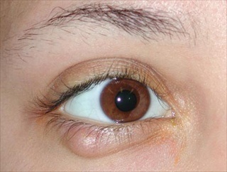 Blefarita, haljazion - demodecoză oculară cu complicații, metode de tratament