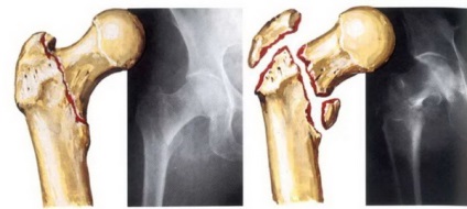 Semne de fractură de șold, diagnostic, tratament, reabilitare, complicații