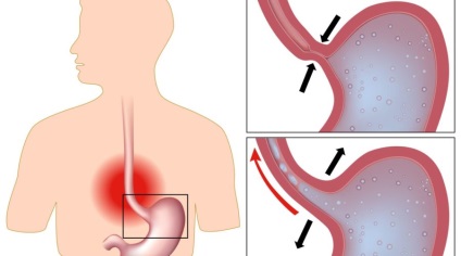 Dieta cu reflux, esofagită, meniuri, dieta cu gerba cu esofagită