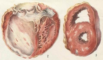 A diffúz cardioszklerózis a fejlődést, a kezelést és a megelőzést okozza