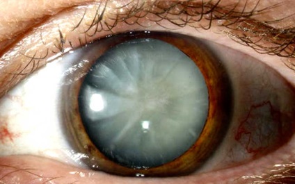 Tratamentul eficient al cataractei cu rețetele bunicii