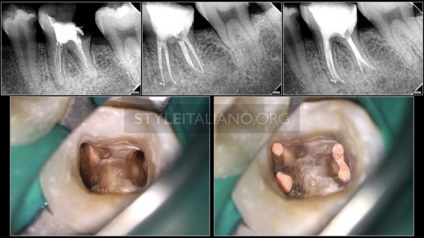 Tratamentul endodontic al sistemului molarilor-rădăcinilor dintelui