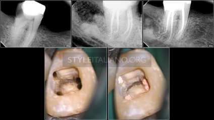 Tratamentul endodontic al sistemului molarilor-rădăcinilor dintelui