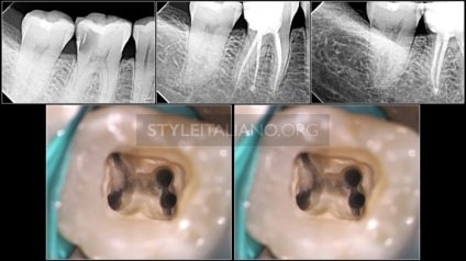 Tratamentul endodontic al sistemului molarilor-rădăcinilor dintelui