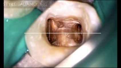 Tratamentul endodontic al sistemului molarilor-rădăcinilor dintelui