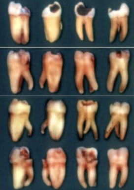 Tratamentul endodontic al sistemului molarilor-rădăcinilor dintelui