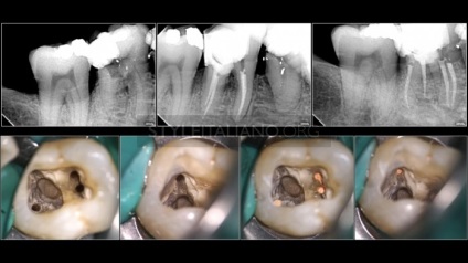 Tratamentul endodontic al sistemului molarilor-rădăcinilor dintelui