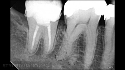 Tratamentul endodontic al sistemului molarilor-rădăcinilor dintelui