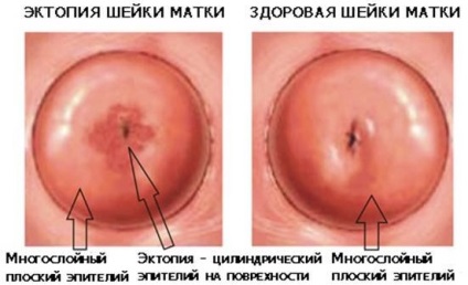 Eroziunea cervicală
