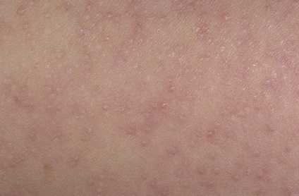 Dermatită foliculară - ce este?