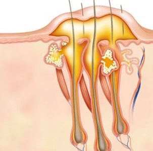 Furunculoza cauzei și tratamentul bolii, simptome