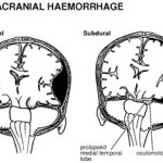 Hemipareză, secretele medicinei populare