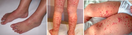 Hemorrhagiás vasculitis - manifesztációk, diagnózis és kezelés