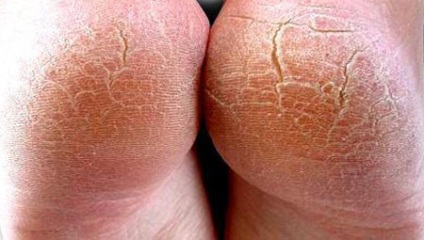 Hyperkeratosis - bőr és lapos epithelium fotó, kezelés, gyógyszerek, zdrab-lab