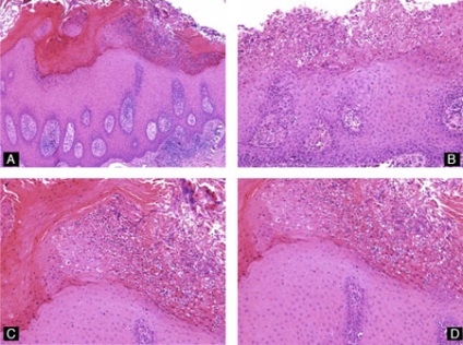 Hyperkeratosis - bőr és lapos epithelium fotó, kezelés, gyógyszerek, zdrab-lab