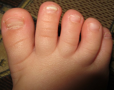 Гъбички на ноктите при деца гъбички лечение в подножието и между пръстите на краката на детето