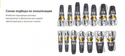 Implantátumok superline (superline), telepítése fogászati ​​implantátumok superline az USA-ból Moszkvában