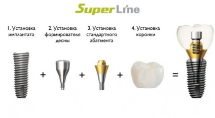 Implantátumok superline (superline), telepítése fogászati ​​implantátumok superline az USA-ból Moszkvában