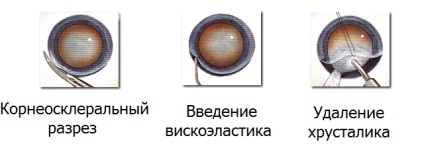 Extracția intracapsulară a cataractei (ikek) - o operațiune de înlocuire a lentilei cu cataractă