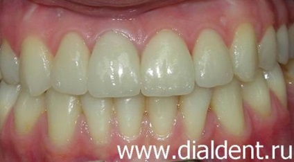 Corectarea ocluziunii și restaurarea ulterioară a dinților cu furnir