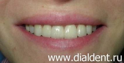 Corectarea ocluziunii și restaurarea ulterioară a dinților cu furnir