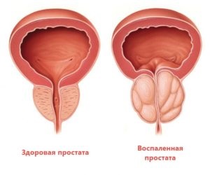 Иван чай за мъже - лечение върба чай ДПХ