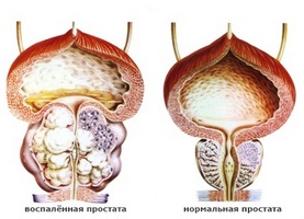 Ce ierburi cu adenom de prostată sunt folosite