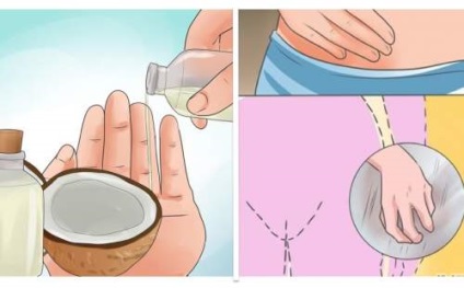 Cum să utilizați ulei de nucă de cocos pentru a trata infecția cu drojdie