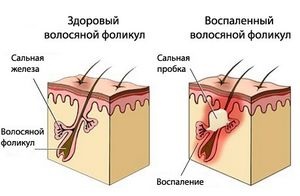 Як лікувати жирне волосся в домашніх умовах