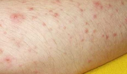 Modul în care moluscul contagios se manifestă la adulți și copii, boli ale pielii