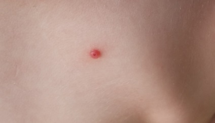 Modul în care moluscul contagios se manifestă la adulți și copii, boli ale pielii