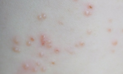 Hogyan terjed a fertőző pikkelysömör felnőttekben és gyermekekben, bőrbetegségekben