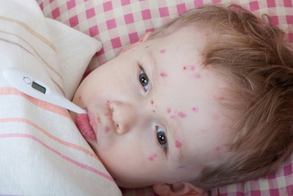 Cum varicela la copii recunoaște boala prin simptome și manifestări