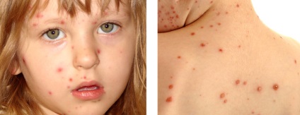 Cum varicela la copii recunoaște boala prin simptome și manifestări