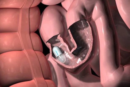 Endoscopia capsulară a indicațiilor intestinului și contraindicații