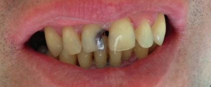 Carii rădăcinii dentare - simptome și tratament