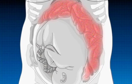 Intestin și sarcină