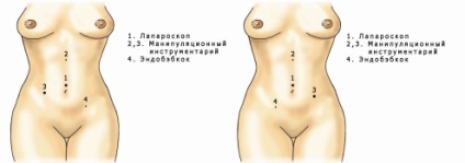 Nefropexia laparoscopică este un chirurg