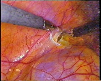 Nefropexia laparoscopică este un chirurg