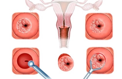 Tratamentul eroziunii cervicale la un preț accesibil în 