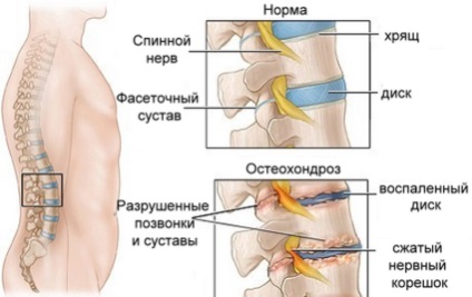 Tratamentul osteocondrozei coloanei vertebrale cervicale, medicamente