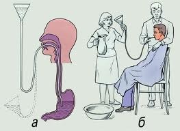 Tratamentul arsurilor esofagului și a primului ajutor