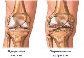 A veleszületett patológiát, traumát, arthrosist és ízületi gyulladást okozó közös kezelés