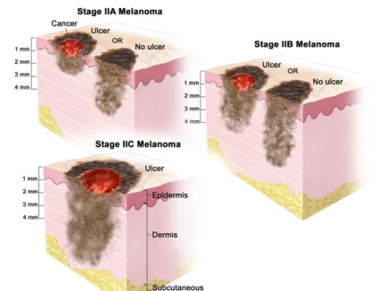 A melanoma veszélyesebb, mint amilyennek látszik, a tünetek, hogy ez a videó