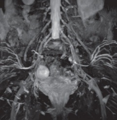 Murg neurografie - investigarea nervilor periferici ai plexului sacral și brahial