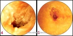 Otita externă - endoscopie ureche - otorinolaringologie - chirurgie cap și gât