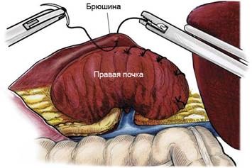 Nefropexia, urologul meu