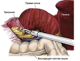 Nephropexia, urológusom