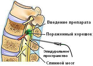 Tratamentul non-invaziv al discurilor intervertebrale herniate din Ucraina